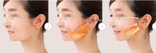 韩国VG百利酷整形外科拉皮手术