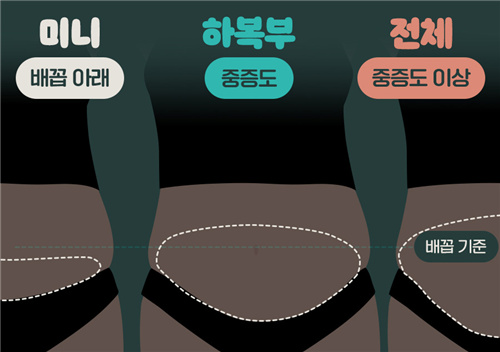韩国WJ原辰整形外科腹壁整形三种阶段和对应改善区域