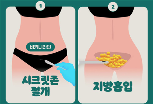 韩国WJ原辰腹壁整形手术特色