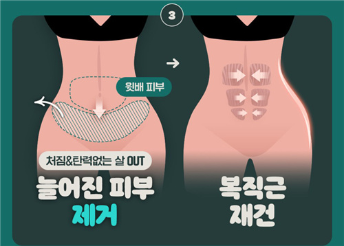 韩国WJ原辰重度腹壁下垂改善方式