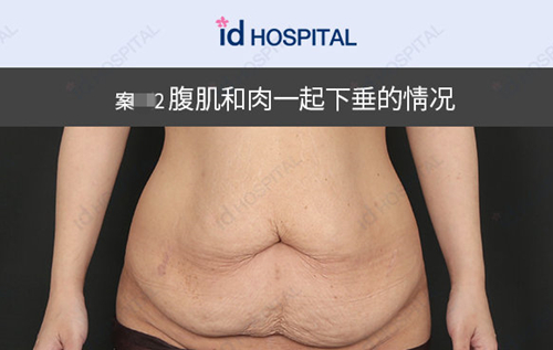 腹部皮肤肌肉松垂怎么恢复？韩国id整形腹部整形手术危险吗