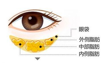 去眼袋手术示意图