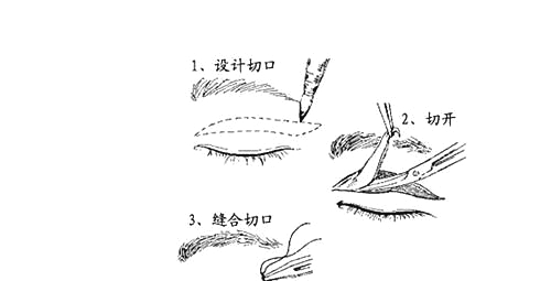 雙眼皮手術示意圖