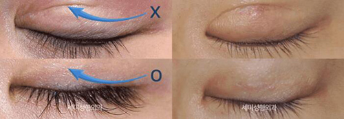 韩国朴相炫修复双眼皮优势盘点!包含各种复杂眼修复对比图!