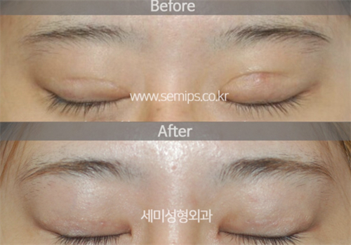 韩国世美整形外科肉条眼修复疤痕修复情况对比