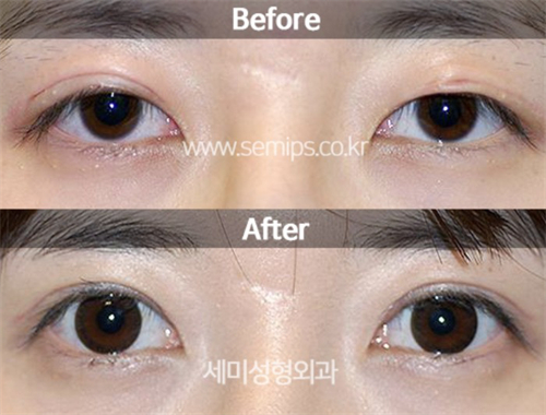 韩国世美整形外科双眼皮修复对比