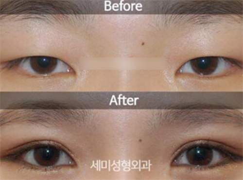 韩国世美整形外科双眼皮对比图