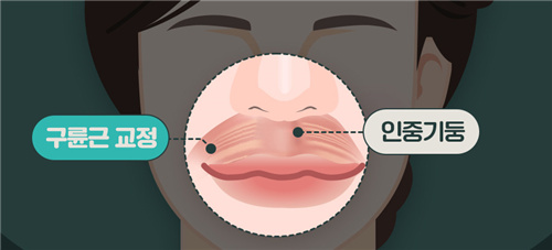 韩国WJ原辰整形外科唇腭裂手术唇部肌肉