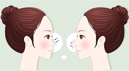 韩国欧佩拉整形医院鼻子整形图