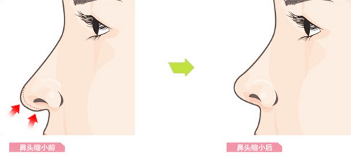 鼻头鼻翼缩小术病例卡通图