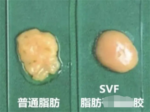 普通脂肪与脂肪胶示意图