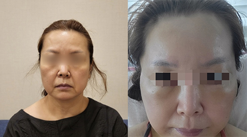 韩国迪美整形美容医院前额提拉手术示例