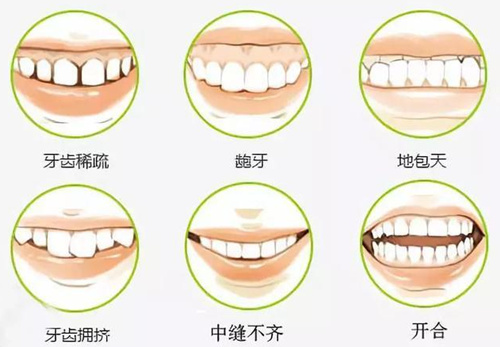 各类牙体错颌示意图