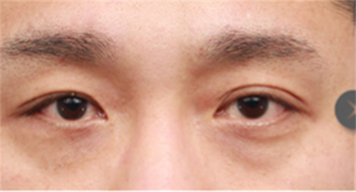 韩国SNOW整形外科眼底脂肪重置术前图