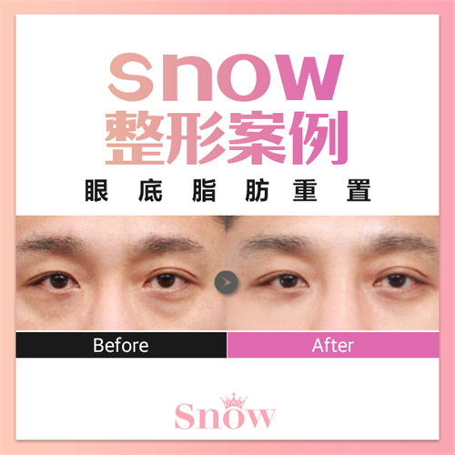 韩国SNOW整形外科眼底脂肪重置对比照