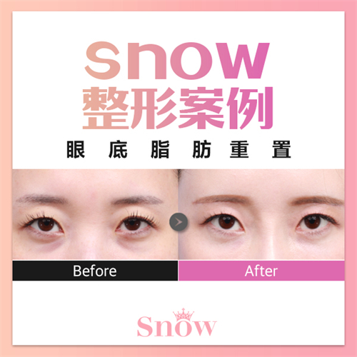 韩国SNOW整形外科眼底脂肪重排对比图