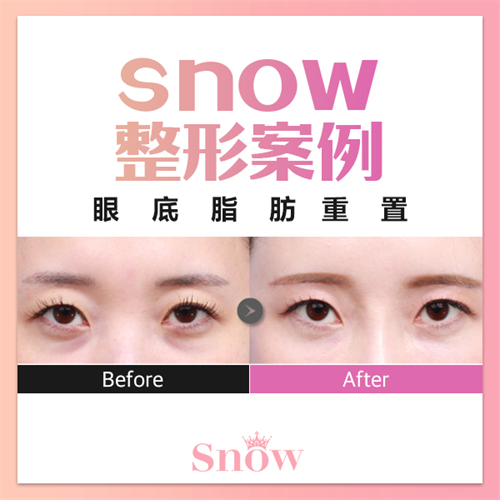 韓國SNOW整形外科眼底脂肪重排對比圖