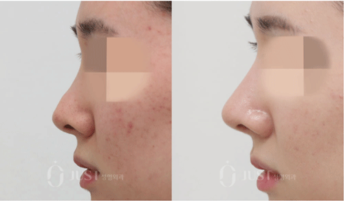 韩国just整形鼻子修复手术前后侧面图片