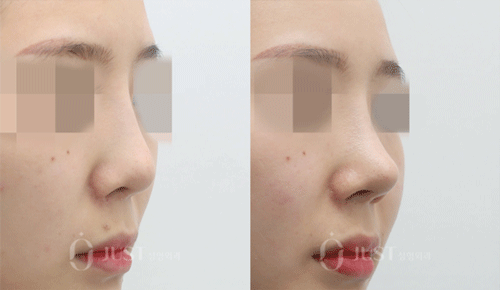韩国just整形做鼻子修复手术照片