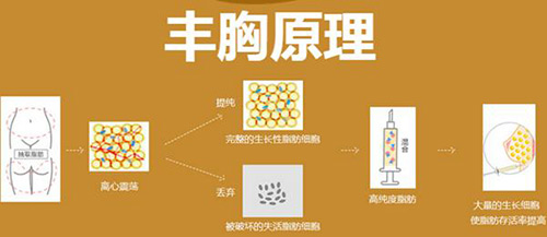 脂肪丰胸原理示意图