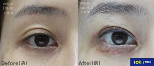 韩国IOU整形外科双眼皮修复前后