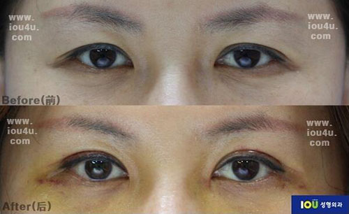 韩国IOU整形外科祛除眼部脂肪手术前后
