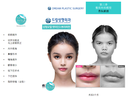 韩国梦想整形外科真人整形前后图
