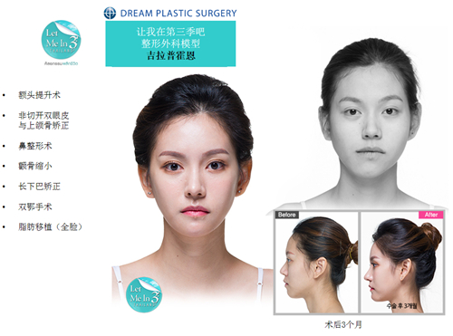 韩国梦想整形外科整形对比照