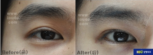 韩国iou整形外科眼部修复手术图片