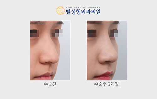 韩国星愿整形外科驼峰鼻手术前后