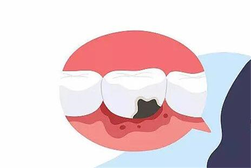 牙齿损坏示意图