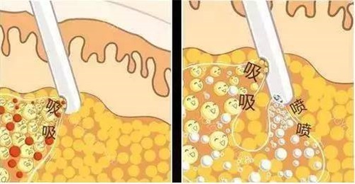 韩国芙莱思整形医院脂肪移植图