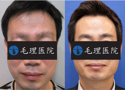 韩国毛理医院眉毛移植手术图片