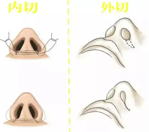 鼻翼缩小手术方法展示