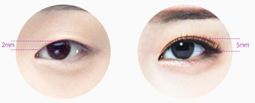 韩国秀美颜整形双眼皮手术特点