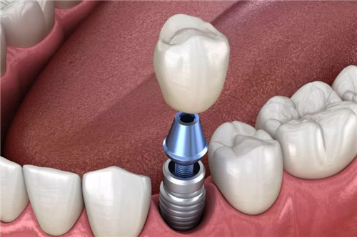 单颗牙种植示意图