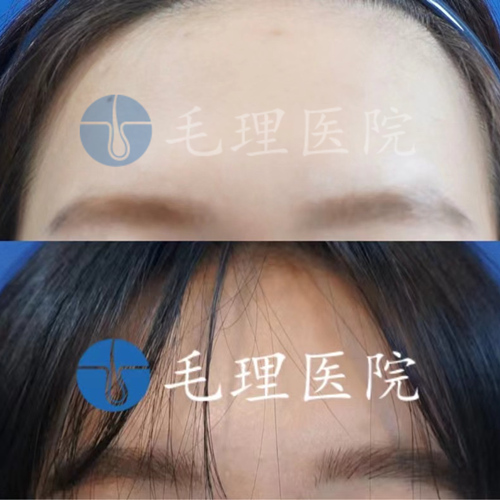 女性眉毛移植图片