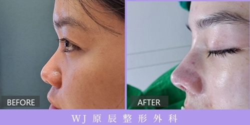 韩国WJ隆鼻手术