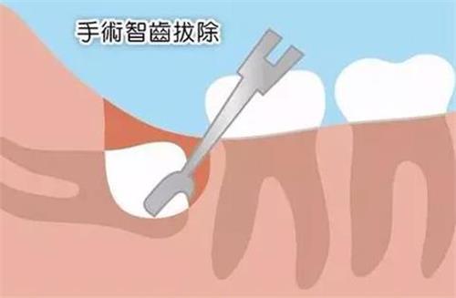 想知道新疆拔智齿多少钱?公布乌市正规口腔医院拔智齿价格