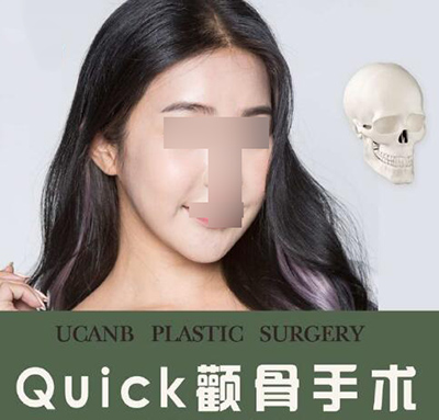韩国Quick颧骨手术展示