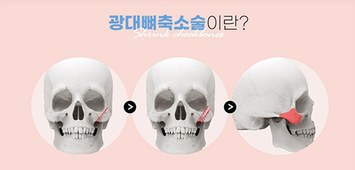 韩国ucanb整形外科颧骨手术