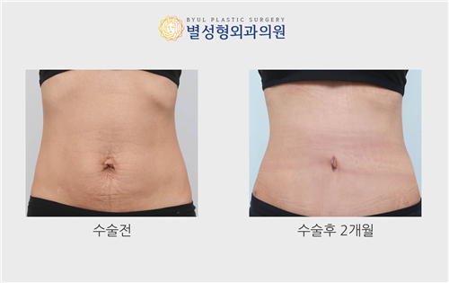 韩国星愿整形医院腹部整形对比图