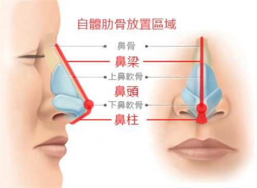 隆鼻手术动画展示图