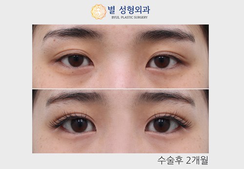 韩国星愿Byul整形医院做双眼皮术后两个月的恢复疗效图片