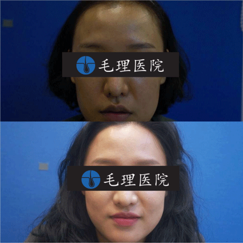 韩国毛理医院发际线移植手术前后照片