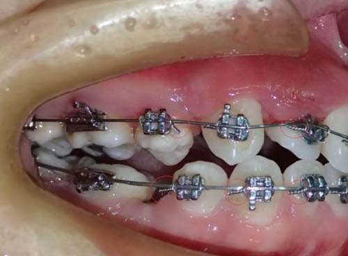 金属牙套矫正过程图