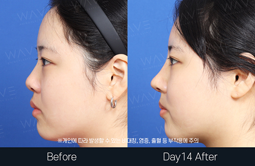 韩国WAVE整形外科隆鼻侧面对比
