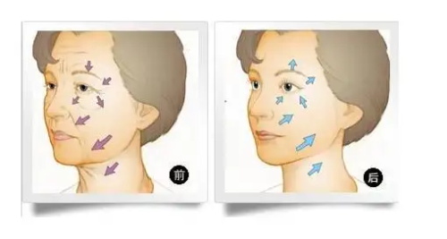 韩国宝士丽整形面部抗衰做的怎么样？提升除皱技术相当好