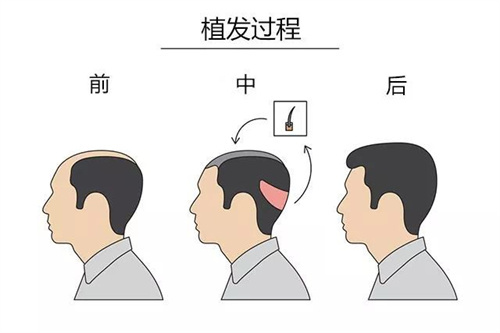 西昌恒美植發(fā)過程