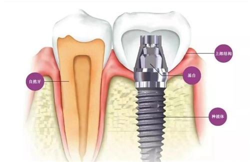 种植牙齿示意图